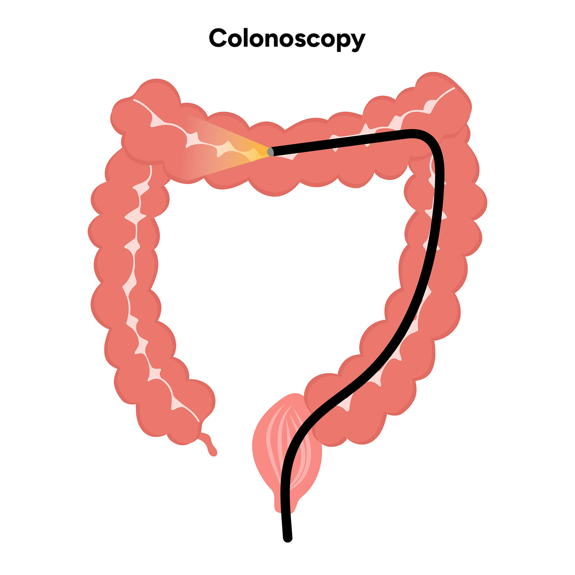 GI-Colonoscopies-Myth-And-FacT