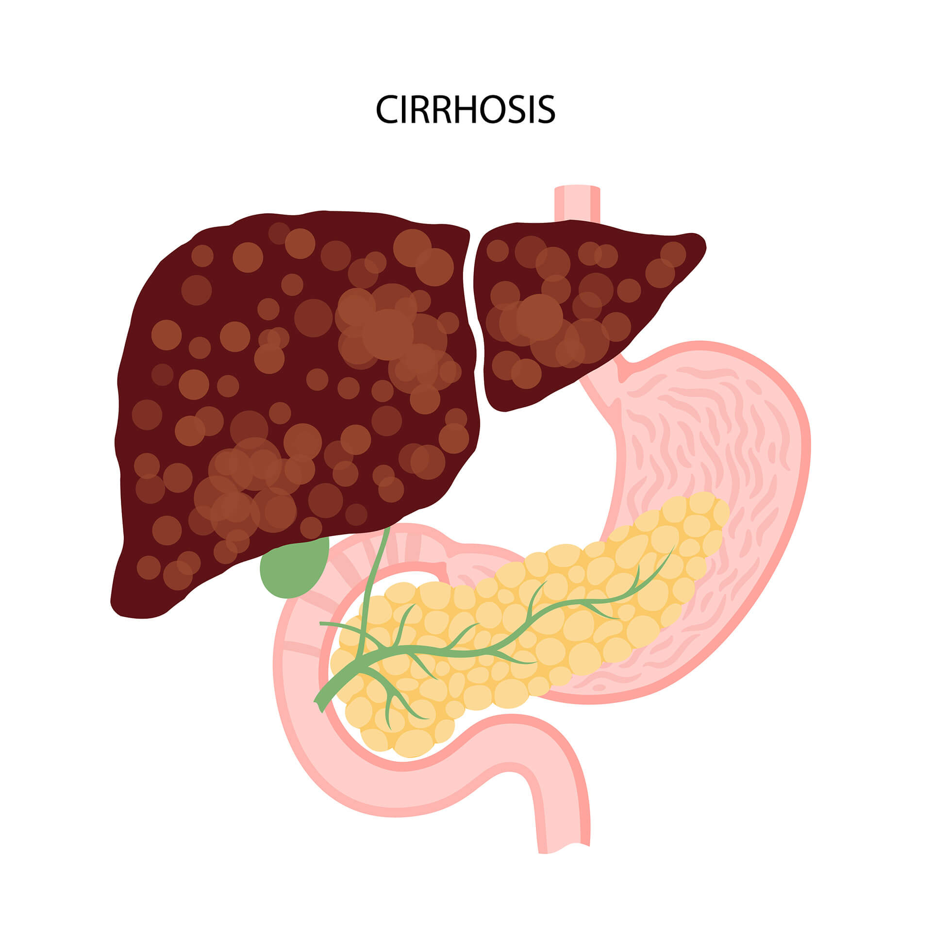 GI-Cirrhosis-Of-The-Liver-Signs,-Stages,-And-Treatments