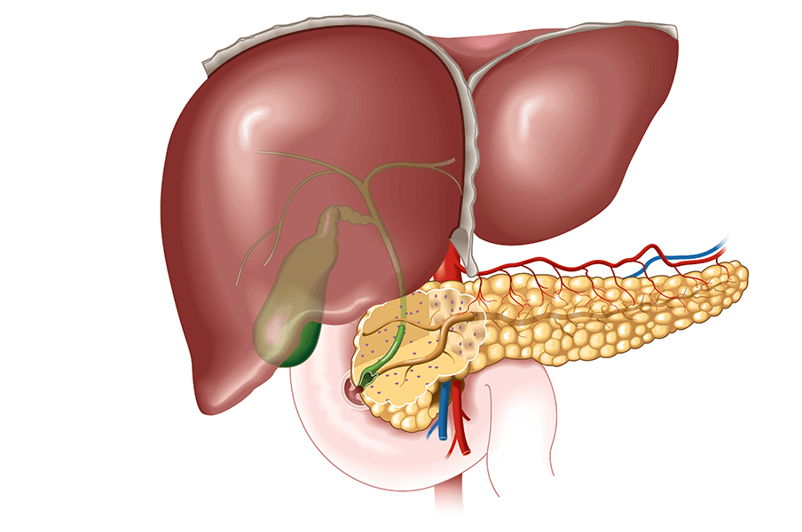 What causes a biliary obstruction?