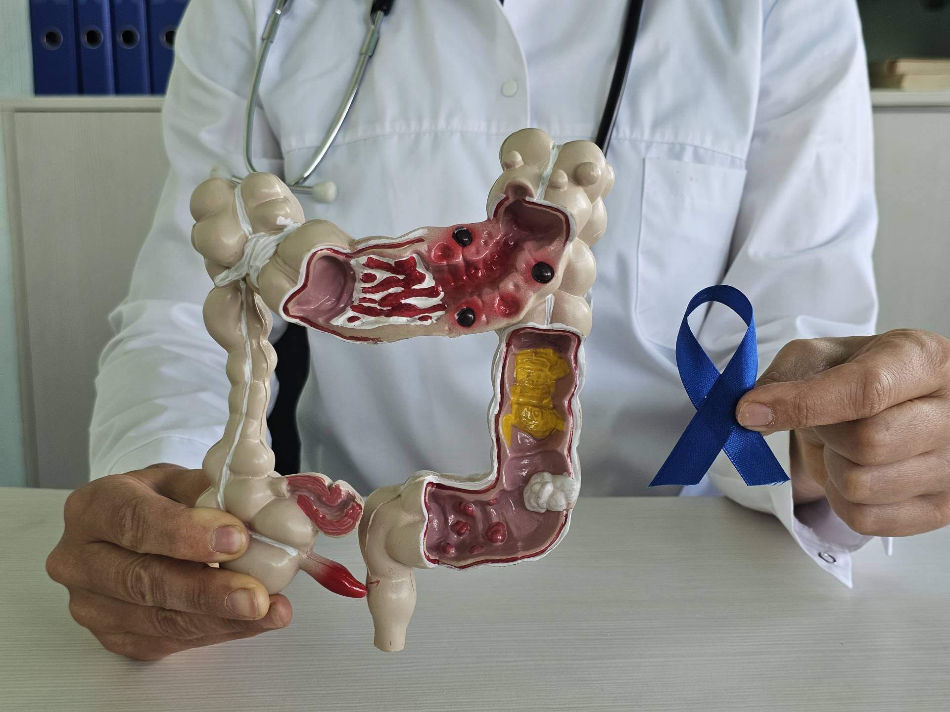 colon cancer